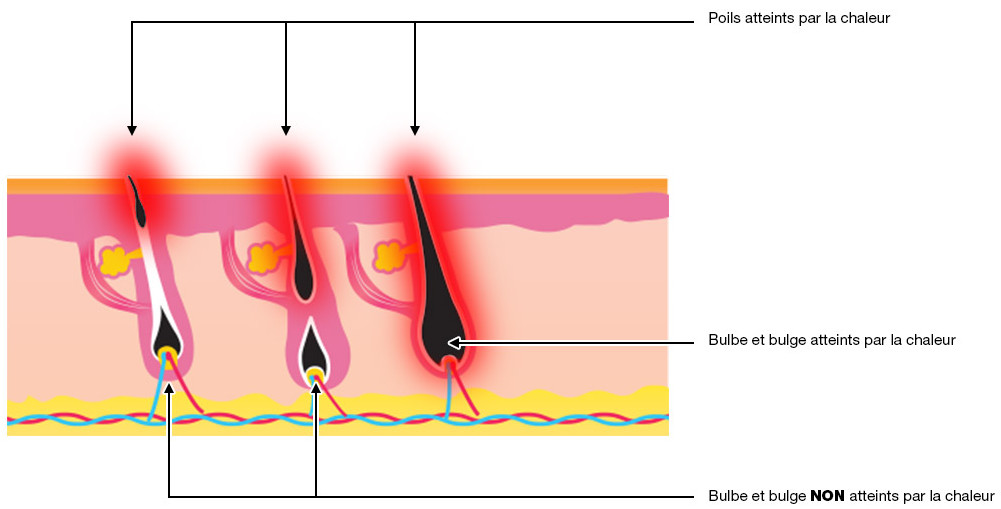 Schéma de la conduction du laser sur le poil