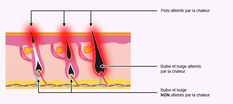 Schéma de la conduction du laser sur le poil