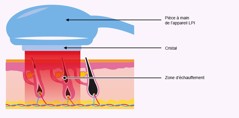 Schéma du passage de la pièce à main du laser sur la zone à épiler