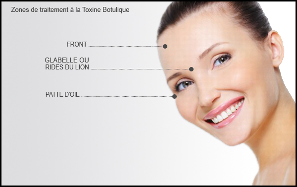 Zones d'injection de Botox pour le visage