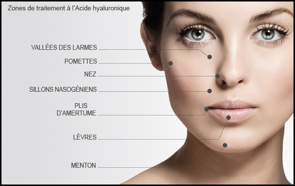 Zones injections d'acide hyaluronique sur le visage